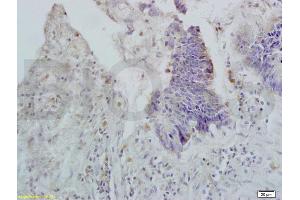 Formalin-fixed and paraffin embedded human rectal carcinoma labeled with Rabbit Anti APOA2 Polyclonal Antibody, Unconjugated (ABIN708686) at 1:200 followed by conjugation to the secondary antibody and DAB staining (APOA2 anticorps  (AA 24-100))
