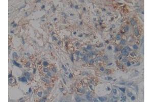 DAB staining on IHC-P; Samples: Human Pancreatic cancer Tissue (NME4 anticorps  (AA 67-185))