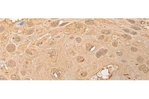 Immunohistochemistry of paraffin-embedded Human esophagus cancer tissue using CPNE3 Polyclonal Antibody at dilution of 1:40(x200) (Copine III anticorps)