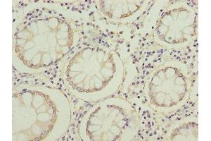 Immunohistochemistry of paraffin-embedded human colon cancer using ABIN7152640 at dilution of 1:100 (FABP1 anticorps  (AA 1-127))