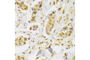 Immunohistochemistry of paraffin-embedded human breast cancer using Slug Antibody (ABIN6127298, ABIN6148181, ABIN6148183 and ABIN6217314) at dilution of 1:100 (40x lens).