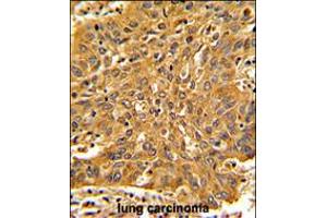 Formalin-fixed and paraffin-embedded human lung carcinoma with Fascin Antibody , which was peroxidase-conjugated to the secondary antibody, followed by DAB staining. (Fascin anticorps  (AA 322-350))