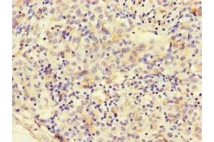 Immunohistochemistry of paraffin-embedded human lung cancer using ABIN7160331 at dilution of 1:100 (FAT Atypical Cadherin 2 (FAT2) (AA 123-314) anticorps)