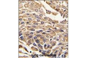 Formalin-fixed and paraffin-embedded human lung carcinoma tissue reacted with ARSB antibody (C-term) (ABIN391670 and ABIN2841581) , which was peroxidase-conjugated to the secondary antibody, followed by DAB staining. (Arylsulfatase B anticorps  (C-Term))