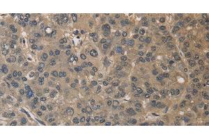 Immunohistochemistry of paraffin-embedded Human liver cancer using DRG1 Polyclonal Antibody at dilution of 1:30