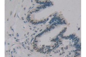 Detection of IGFBP1 in Human Pancreatic cancer Tissue using Polyclonal Antibody to Insulin Like Growth Factor Binding Protein 1 (IGFBP1)