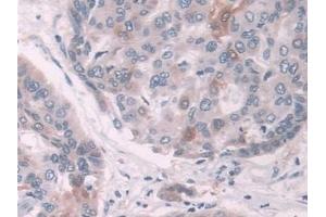 Detection of NQO1 in Human Liver cancer Tissue using Polyclonal Antibody to NADH Dehydrogenase, Quinone 1 (NQO1)