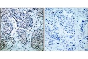 Immunohistochemistry analysis of paraffin-embedded human breast carcinoma, using SEK1/MKK4 (Phospho-Thr261) Antibody.