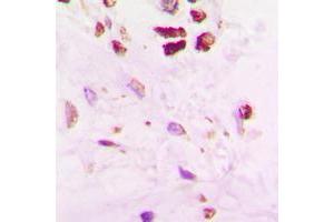 Immunohistochemical analysis of SENP5 staining in human lung cancer formalin fixed paraffin embedded tissue section.