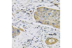 Immunohistochemistry of paraffin-embedded human lung cancer using KRT20 Antibody (ABIN5970078) at dilution of 1/100 (40x lens). (KRT20 anticorps)