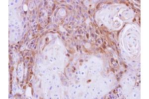 IHC-P Image Peripherin antibody detects PRPH protein at cytosol on Ca922 xenograft by immunohistochemical analysis. (Peripherin anticorps)