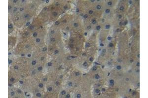 Detection of NNMT in Human Liver cancer Tissue using Polyclonal Antibody to Nicotinamide-N-Methyltransferase (NNMT)