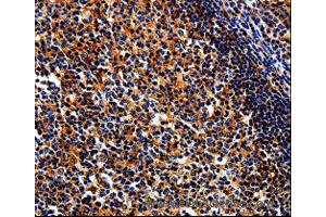 Immunohistochemistry of Human liver cancer using BIRC6 Polyclonal Antibody at dilution of 1:50 (BIRC6 anticorps)