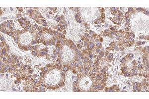 ABIN6279308 at 1/100 staining Human liver cancer tissue by IHC-P. (Claudin 23 anticorps  (Internal Region))