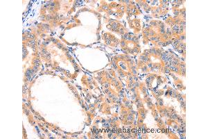 Immunohistochemistry of Human thyroid cancer using PRDX2 Polyclonal Antibody at dilution of 1:80 (Peroxiredoxin 2 anticorps)