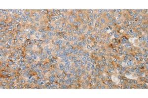 Immunohistochemistry of paraffin-embedded Human liver cancer using IGFBP1 Polyclonal Antibody at dilution of 1:30 (IGFBPI anticorps)
