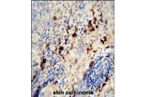 LCE1A antibody immunohistochemistry analysis in formalin fixed and paraffin embedded human skin carcinoma followed by peroxidase conjugation of the secondary antibody and DAB staining. (LCE1A anticorps  (C-Term))