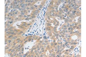 The image on the left is immunohistochemistry of paraffin-embedded Human ovarian cancer tissue using ABIN7192728(TACR2 Antibody) at dilution 1/20, on the right is treated with synthetic peptide. (TACR2 anticorps)