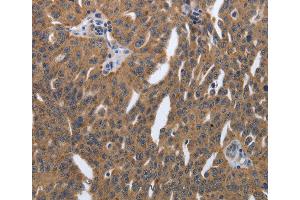 Immunohistochemistry of Human lung cancer using PDGFA Polyclonal Antibody at dilution of 1:40 (PDGFA anticorps)