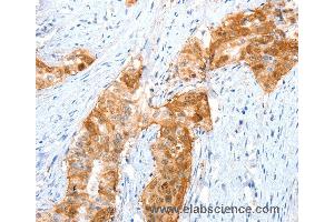 Immunohistochemistry of Human cervical cancer using ANXA8 Polyclonal Antibody at dilution of 1:35 (Annexin VIII anticorps)