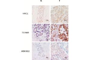 Representative IHC of non-neoplastic (N) and triple-negative breast cancer (T) tissues of VWCE, TSPAN9 and ADAM12 proteins.