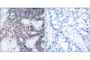 Immunohistochemistry analysis of paraffin-embedded human breast carcinoma, using MEK1/2 (Phospho-Ser217) Antibody. (MEK1/2 anticorps  (pSer218))