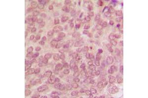 Immunohistochemical analysis of p53 (pS315) staining in human breast cancer formalin fixed paraffin embedded tissue section. (p53 anticorps  (C-Term, pSer315))