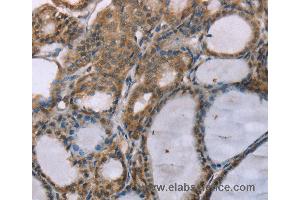 Immunohistochemistry of Human thyroid cancer using ACTN2 Polyclonal Antibody at dilution of 1:30 (ACTN2 anticorps)