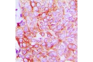 Immunohistochemical analysis of ATP1A1 staining in human breast cancer formalin fixed paraffin embedded tissue section.