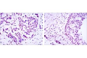 Immunohistochemical analysis of paraffin-embedded breast cancer (left) and ovarian cancer (right) using CRTC3 mouse mAb with DAB staining.