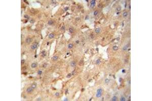 NEU4 antibody immunohistochemistry analysis in formalin fixed and paraffin embedded human hepatocarcinoma.