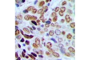 Immunohistochemical analysis of HP1 gamma (pS93) staining in human prostate cancer formalin fixed paraffin embedded tissue section. (CBX3 anticorps  (pSer93))