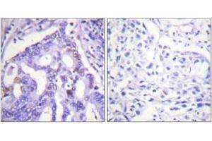 Immunohistochemistry analysis of paraffin-embedded human lung carcinoma tissue, using PIAS4 Antibody. (PIAS4 anticorps  (AA 451-500))