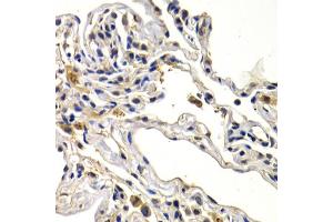 Immunohistochemistry of paraffin-embedded human lung cancer using WNT3A antibody (ABIN6292349) at dilution of 1:200 (40x lens).