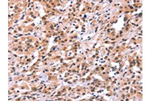 The image on the left is immunohistochemistry of paraffin-embedded Human thyroid cancer tissue using ABIN7191561(MYF5 Antibody) at dilution 1/15, on the right is treated with synthetic peptide. (MYF5 anticorps)