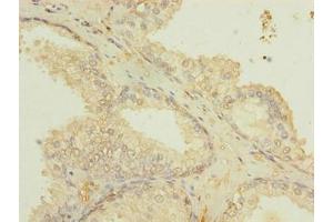 Immunohistochemistry of paraffin-embedded human prostate cancer using ABIN7151502 at dilution of 1:100 (ETFDH anticorps  (AA 34-617))