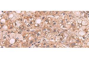 Immunohistochemistry of paraffin-embedded Human liver cancer tissue using PPP2R1A Polyclonal Antibody at dilution of 1:65(x200) (PPP2R1A anticorps)