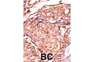 Formalin-fixed and paraffin-embedded human cancer tissue reacted with the primary antibody, which was peroxidase-conjugated to the secondary antibody, followed by AEC staining. (C-JUN anticorps  (pSer63))