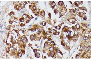 Immunohistochemistry of paraffin-embedded Human liver cancer using AGT Polyclonal Antibody at dilution of 1:100 (40x lens). (AGT anticorps)