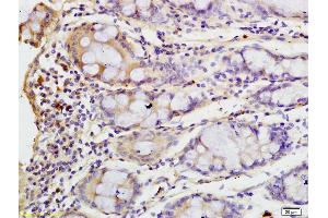 Formalin-fixed and paraffin embedded human colon carcinoma labeled with Anti-Clathrin heavy chain Polyclonal Antibody, Unconjugated (ABIN681883) at 1:200 followed by conjugation to the secondary antibody and DAB staining