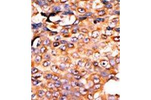 Formalin-fixed and paraffin-embedded human cancer tissue reacted with the primary antibody, which was peroxidase-conjugated to the secondary antibody, followed by AEC staining. (PANK3 anticorps  (Middle Region))