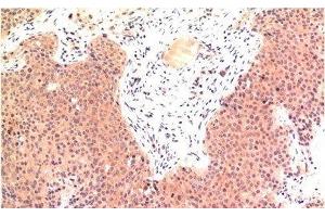 Immunohistochemistry of paraffin-embedded Human colon carcinoma tissue using Epsilon Tubulin Monoclonal Antibody at dilution of 1:200. (TUBE1 anticorps)
