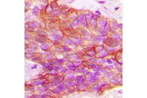 Immunohistochemical analysis of PTTG1IP staining in human breast cancer formalin fixed paraffin embedded tissue section.