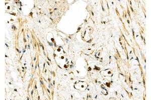 ABIN6262568 and ABIN6276793 at 1/100 staining Human ovarian cancer and adjacent normal tissues by IHC-P.