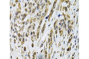 Immunohistochemistry of paraffin-embedded Human gastric cancer using RhoA Polyclonal Antibody at dilution of 1:100 (40x lens). (RHOA anticorps)