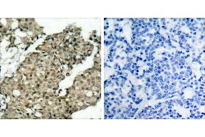 P-Peptide - +Immunohistochemical analysis of paraffin-embedded human breast carcinoma tissue using G3BP-1 (phospho-Ser232) antibody. (G3BP1 anticorps  (pSer232))