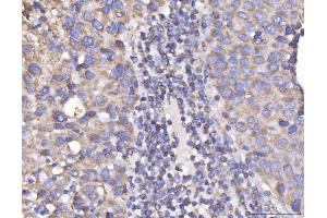IHC analysis of DLST using anti-DLST antibody (ABIN7599412). (DLST anticorps  (AA 1-453))