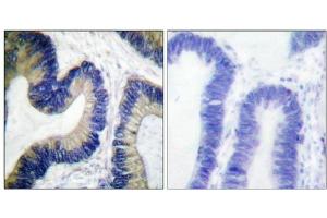mmunohistochemical analysis of paraffin-embedded human colon carcinoma tissue using 4E-BP1 (Phospho-Ser64) antibody.