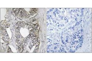 Immunohistochemistry analysis of paraffin-embedded human breast carcinoma tissue, using SAPK/JNK (Ab-183) Antibody. (SAPK, JNK (AA 166-215) anticorps)