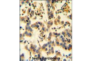 K0090 Antibody immunohistochemistry analysis in formalin fixed and paraffin embedded human testis carcinoma followed by peroxidase conjugation of the secondary antibody and DAB staining. (KIAA0090 anticorps  (C-Term))